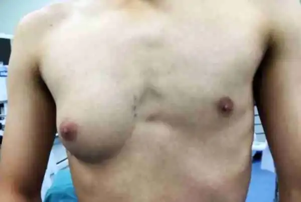 Omg! See The Man Who Mysteriously Grew A Breast Like A Girl On The Right Side Of His Chest (Photos)